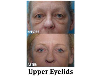 Blepharoplasty Before & After Image