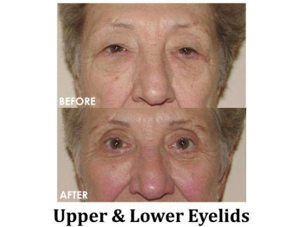 Blepharoplasty Before & After Image
