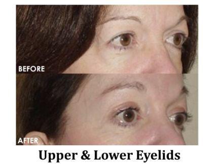 Blepharoplasty Before & After Image