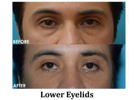 Blepharoplasty Before & After Image