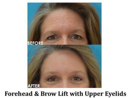 Blepharoplasty Before & After Image