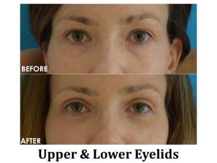 Blepharoplasty Before & After Image