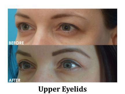 Blepharoplasty Before & After Image