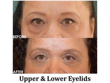 Blepharoplasty Before & After Image