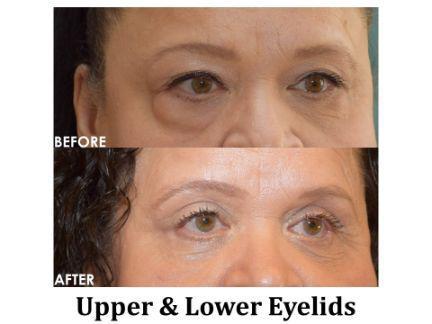 Blepharoplasty Before & After Image