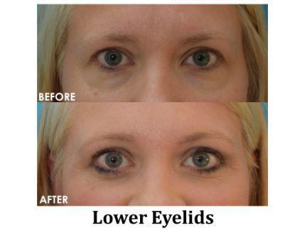 Blepharoplasty Before & After Image
