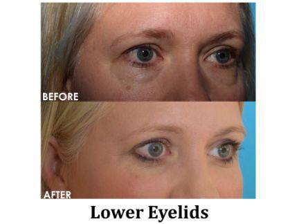 Blepharoplasty Before & After Image