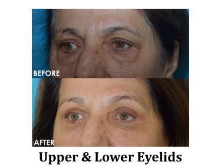 Blepharoplasty Before & After Image
