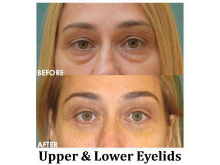Blepharoplasty Before & After Image