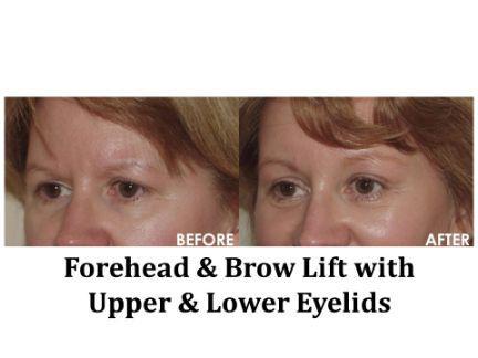 Blepharoplasty Before & After Image