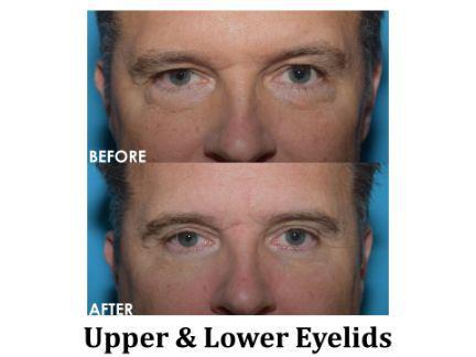 Blepharoplasty Before & After Image
