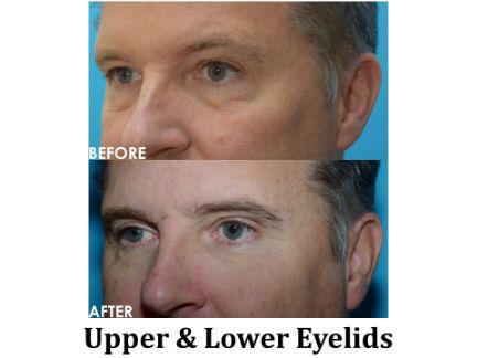 Blepharoplasty Before & After Image