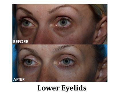 Blepharoplasty Before & After Image