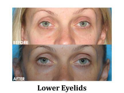 Blepharoplasty Before & After Image