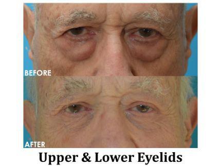 Blepharoplasty Before & After Image