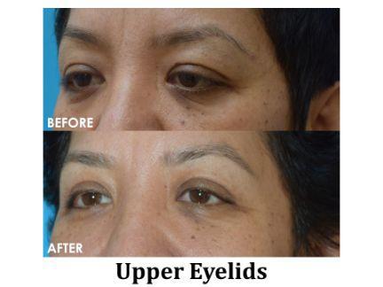 Blepharoplasty Before & After Image