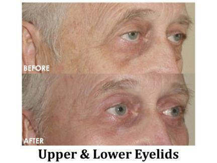 Blepharoplasty Before & After Image
