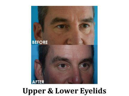Blepharoplasty Before & After Image