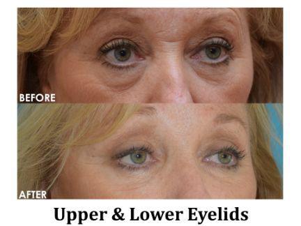 Blepharoplasty Before & After Image