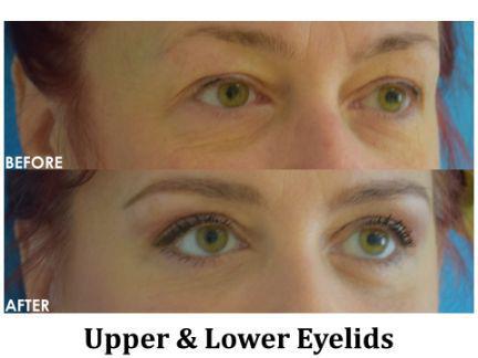 Blepharoplasty Before & After Image