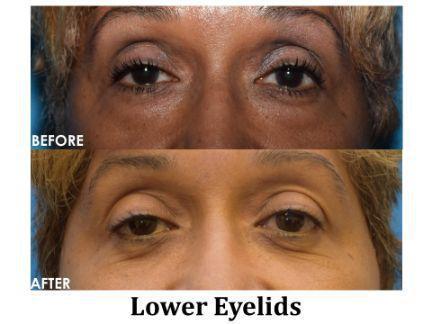 Blepharoplasty Before & After Image