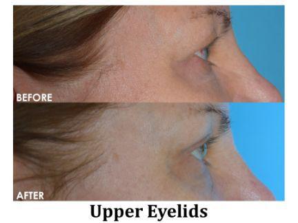 Blepharoplasty Before & After Image