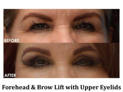 Blepharoplasty Before & After Image