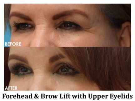 Blepharoplasty Before & After Image