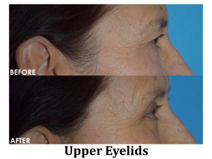 Blepharoplasty Before & After Image