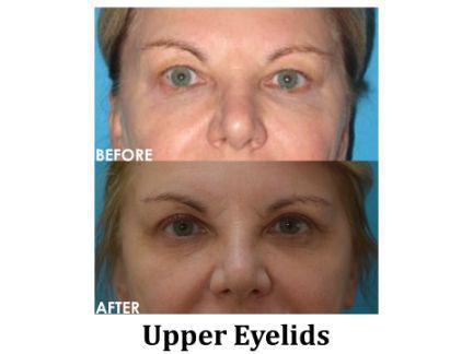 Blepharoplasty Before & After Image