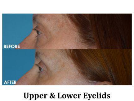Blepharoplasty Before & After Image