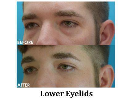 Blepharoplasty Before & After Image