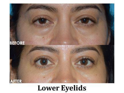 Blepharoplasty Before & After Image