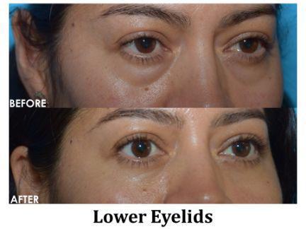 Blepharoplasty Before & After Image