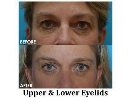 Blepharoplasty Before & After Image