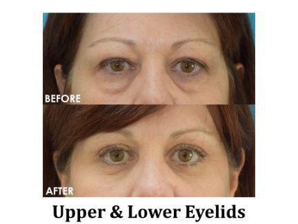 Blepharoplasty Before & After Image