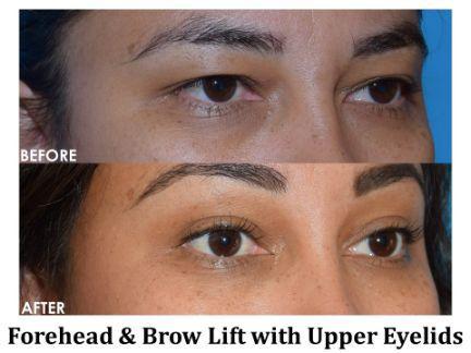 Blepharoplasty Before & After Image