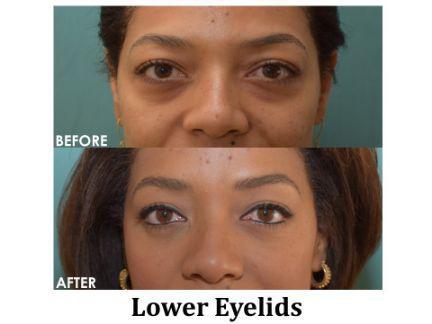 Blepharoplasty Before & After Image