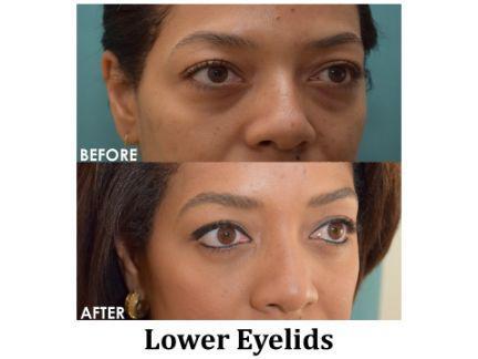 Blepharoplasty Before & After Image