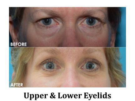 Blepharoplasty Before & After Image