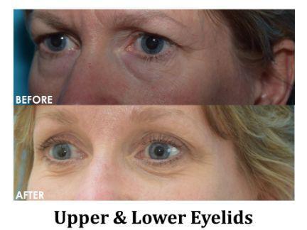 Blepharoplasty Before & After Image