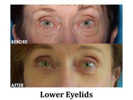 Blepharoplasty Before & After Image