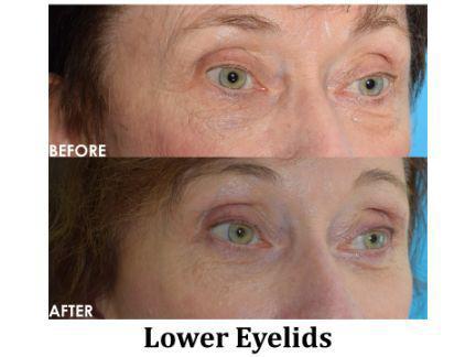 Blepharoplasty Before & After Image