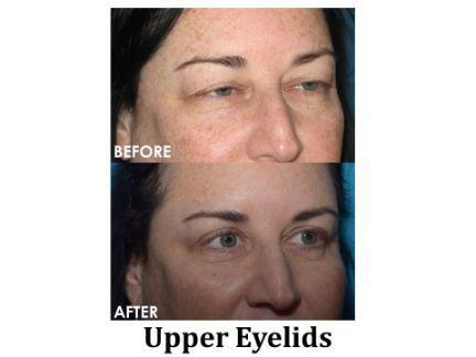 Blepharoplasty Before & After Image