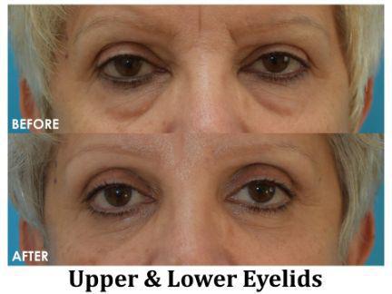 Blepharoplasty Before & After Image