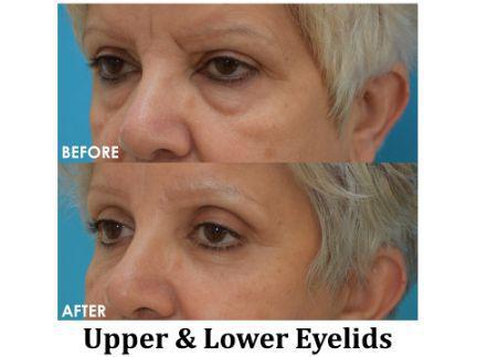 Blepharoplasty Before & After Image