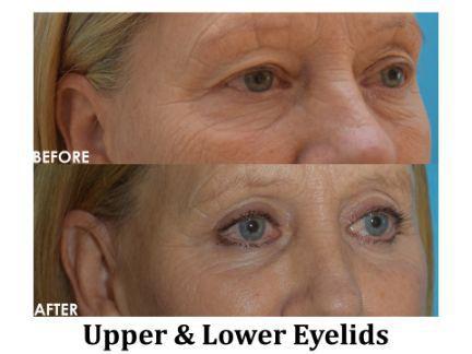 Blepharoplasty Before & After Image