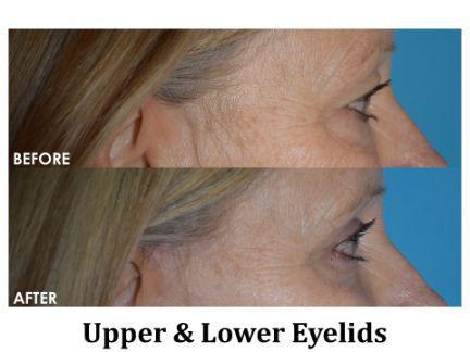 Blepharoplasty Before & After Image