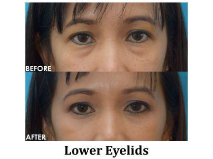 Blepharoplasty Before & After Image