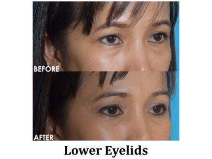 Blepharoplasty Before & After Image